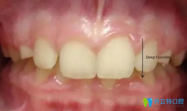 科普:深覆合骨性和牙性的區(qū)別并附骨性和牙性的矯正方法