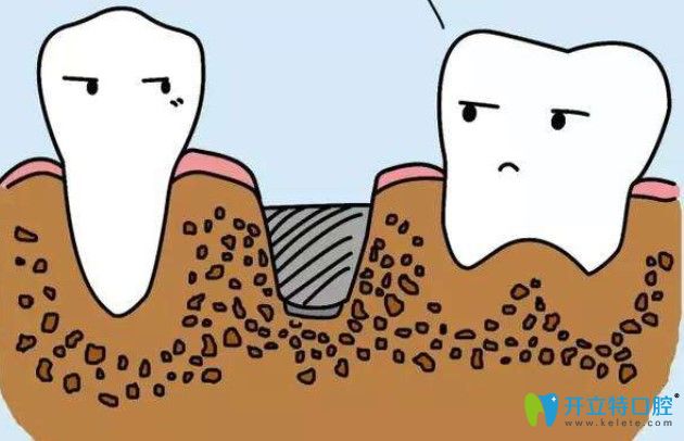 種植牙脫落多久后還能種牙