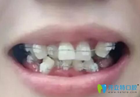 珠海牙齒矯正價格不妨看看我在九龍口腔花1萬多矯牙后效果