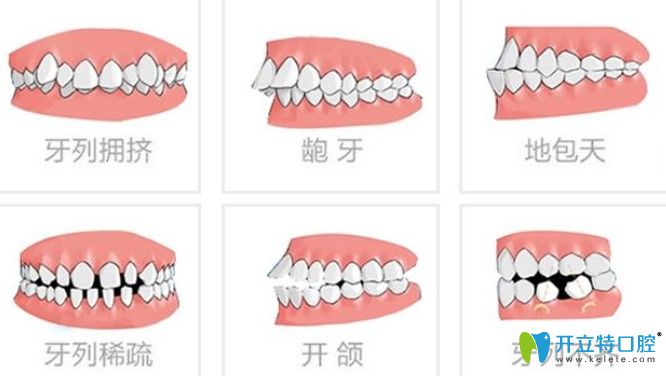 哪些牙齒問題可以做半隱形牙齒矯正