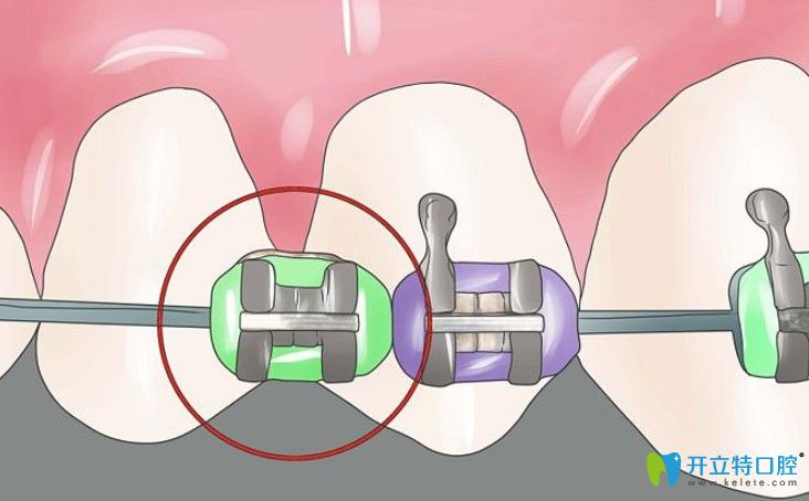 美國(guó)ormco（奧美科）與3m自鎖托槽矯正哪個(gè)好？及價(jià)格分享