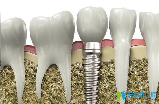 汪醫(yī)生科普種植牙