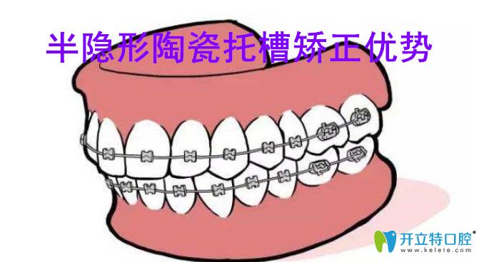 半隱形陶瓷托槽矯正優(yōu)勢