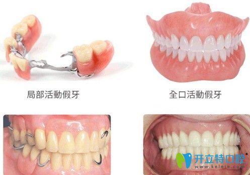 汪醫(yī)生指出大家只要弄清楚這三種修復(fù)方式的優(yōu)缺點(diǎn)之后就知道該如何選擇