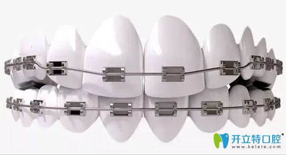 做了4顆烤瓷牙還能做正畸嗎,烤瓷牙在矯正時會影響移動吧