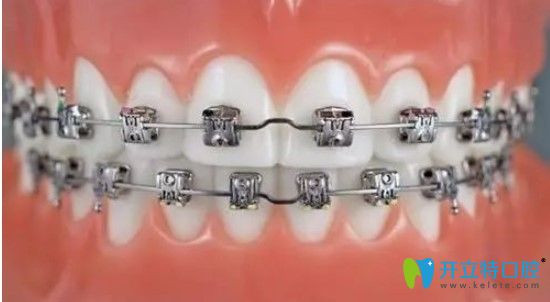 美國3m自鎖托槽矯正優(yōu)勢