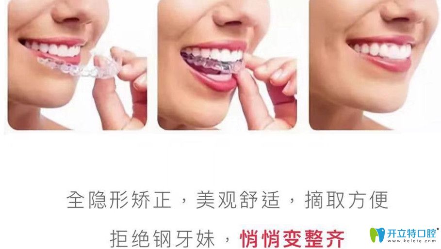 全隱形矯正距離美更進一步