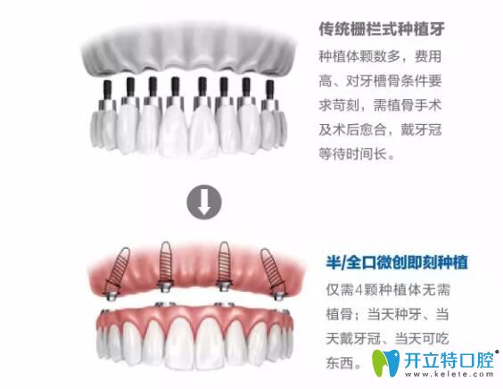 即刻種植優(yōu)勢