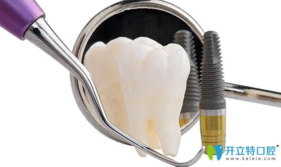 種植體的質(zhì)量怎么樣