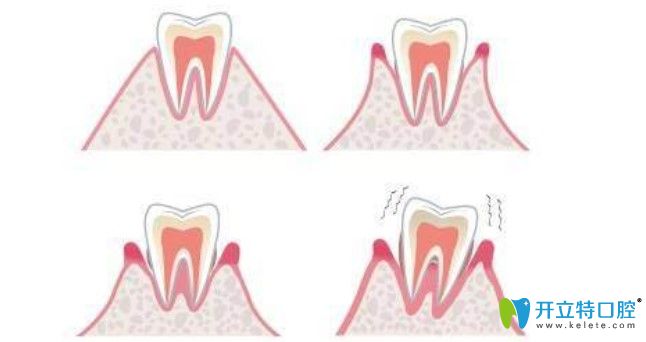 王維偉醫(yī)生科普牙周炎程度發(fā)展到后來