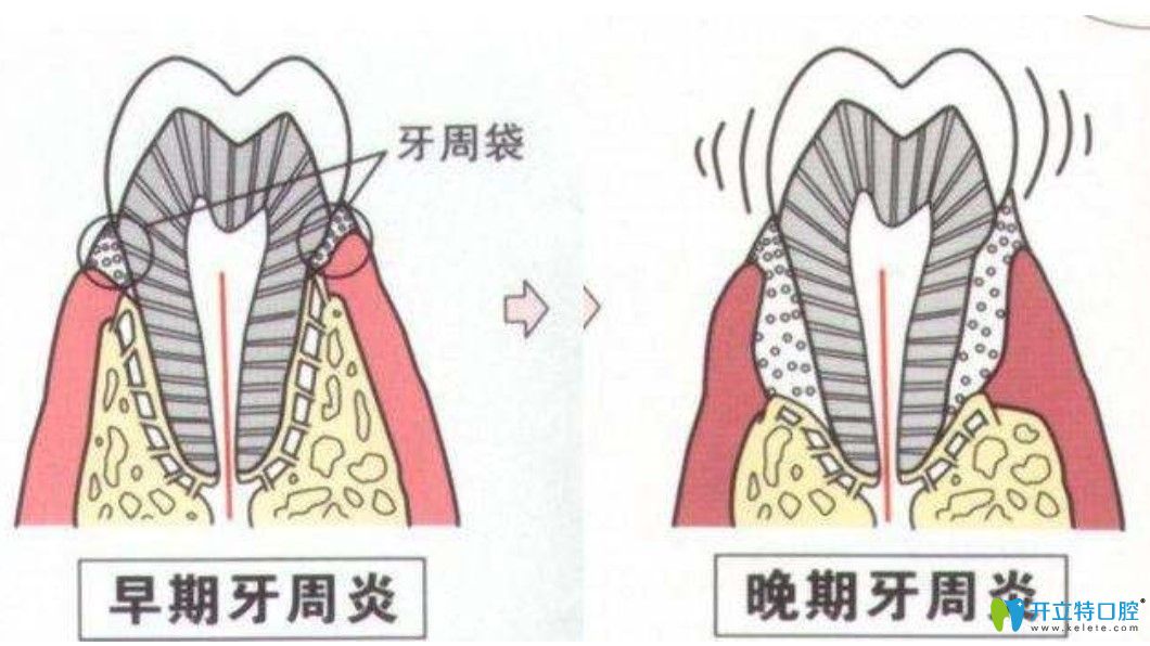 王維偉醫(yī)生科普牙周炎程度怎么區(qū)分