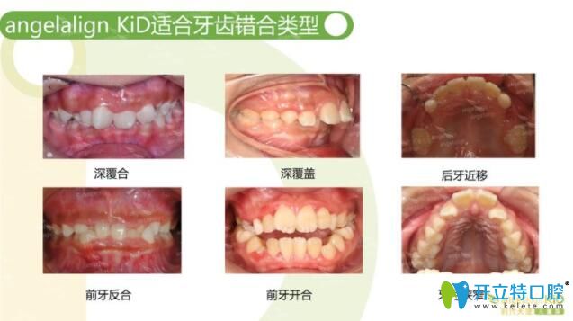 時代天使隱形矯正兒童版的適應癥