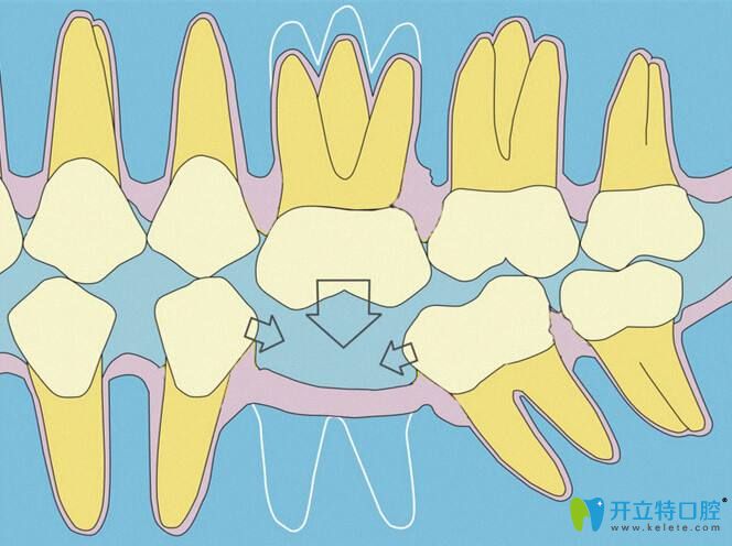 牙齒缺失的危害有哪些