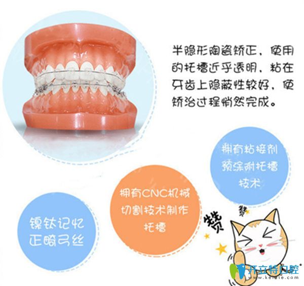 陶瓷托槽半隱形矯正優(yōu)勢