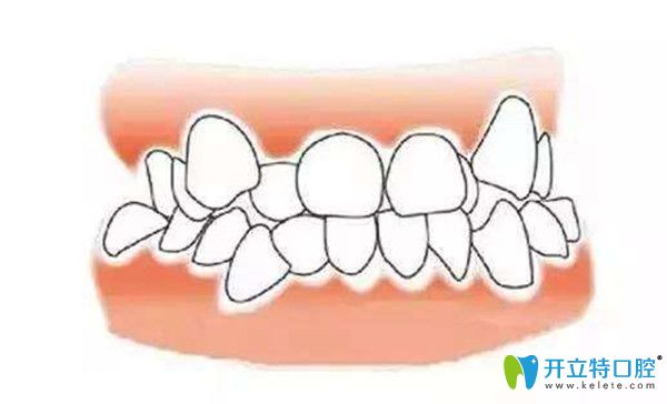 牙齒畸形可以矯正嗎