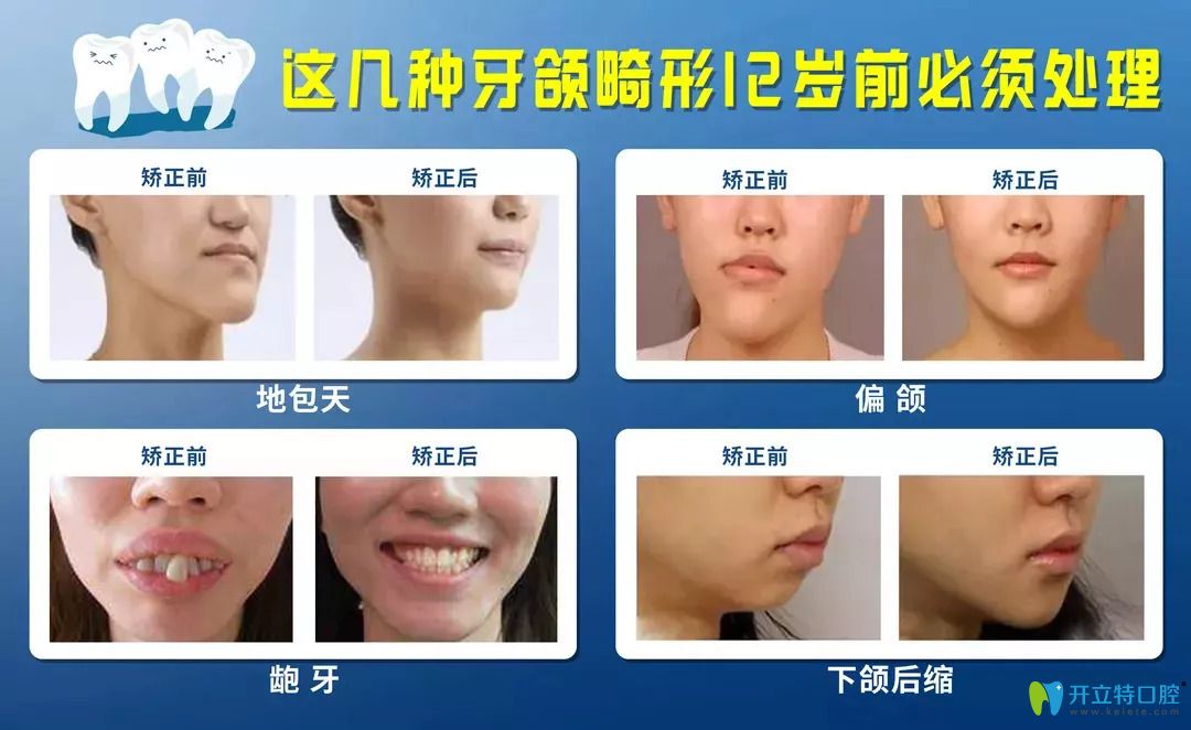 常見的牙頜畸形圖片