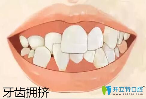 牙頜畸形之牙齒擁擠圖片