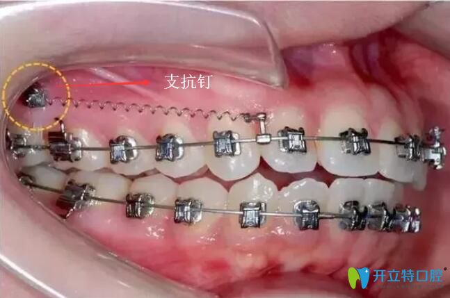 嘴凸正畸一定要打支抗釘嗎?有沒有副作用?矯牙前必看！