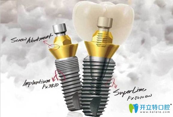韓國(guó)登騰種植牙示意圖
