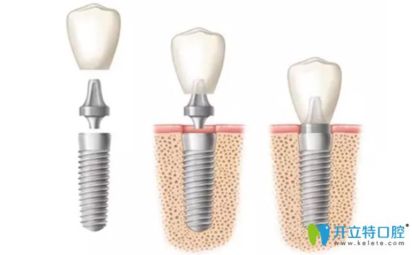 韓國(guó)登特斯種植牙示意圖