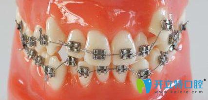 傳統(tǒng)金屬托槽矯正