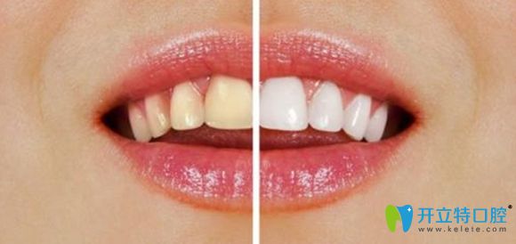 洛陽牙大夫口腔牙齒貼面價格很超值