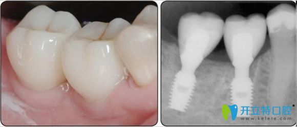 韓國(guó)登特斯種植牙價(jià)格也較便宜