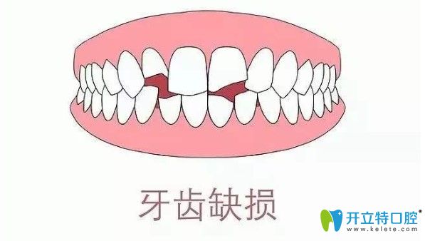 段煉醫(yī)生科普牙齒缺損的修復(fù)方式有哪些