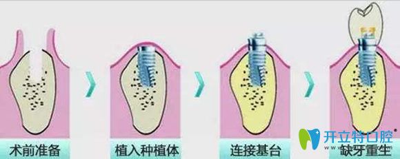 洛陽牙大夫口腔種植牙價格3999元一顆起