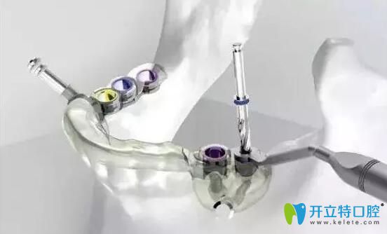 3D導(dǎo)板種植