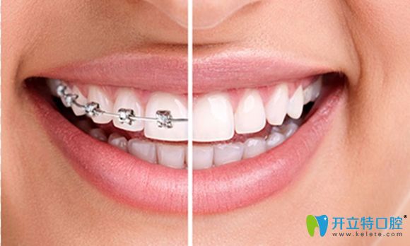 深圳邁兔齒科兒童牙齒矯正5000元起