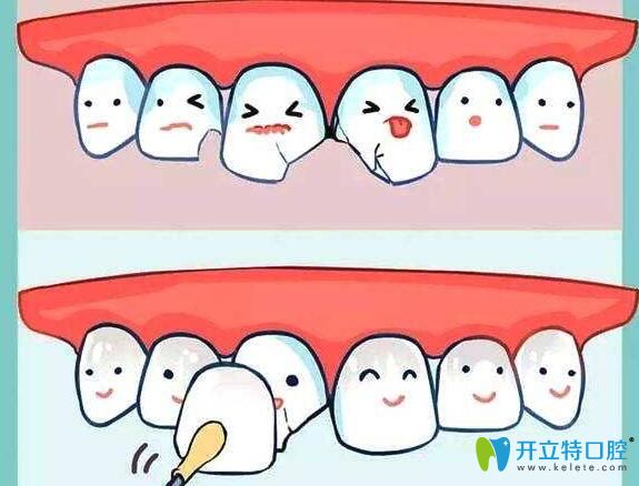 全瓷貼面貼住缺損牙