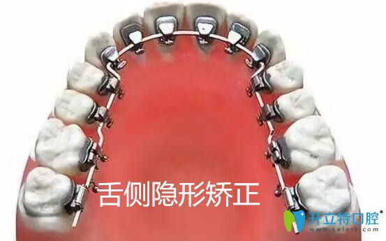 做舌側(cè)牙齒矯正會大舌頭嗎?從舌側(cè)隱形矯正的優(yōu)缺點(diǎn)來了解