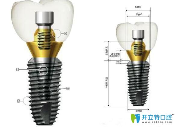 韓國(guó)登騰種植體