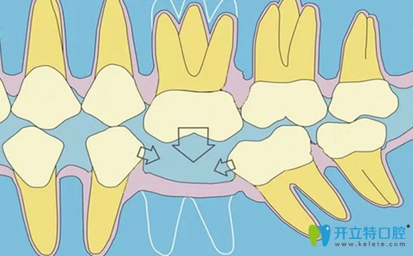 一顆牙齒缺失會影響臨牙的健康