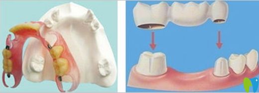 活動(dòng)義齒和固定義齒的區(qū)別圖