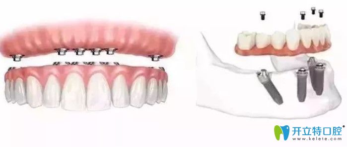 all—on—4半口種植牙價格