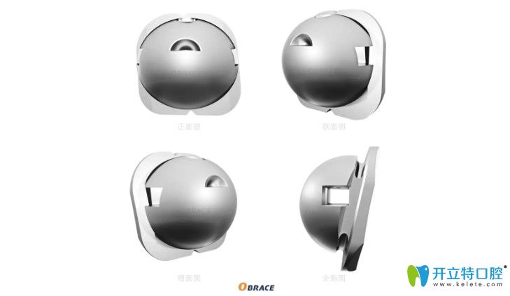 OBrace球面自鎖托槽矯正多少錢