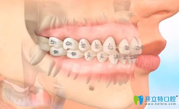<!--<i data=20240703-sp></i>-->矯正牙齒好的醫(yī)院推薦