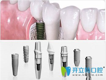 <!--<i data=20240703-sp></i>-->口腔<!--<i data=20240703-sp></i>-->醫(yī)生介紹前牙種植的優(yōu)勢(shì)