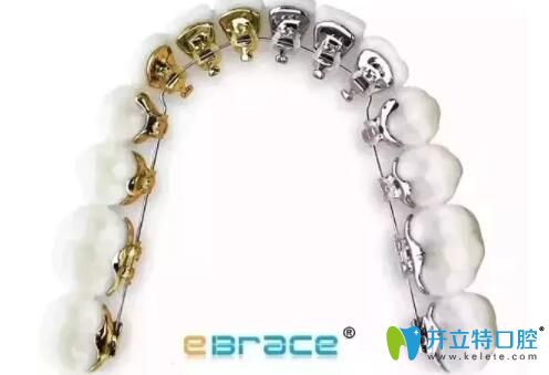 干貨:ebrace舌側(cè)矯正是自鎖的嗎,矯正痛嗎,附ebrace牙套價格
