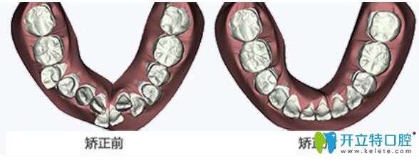 舌側(cè)矯正前后
