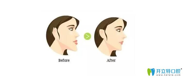 雙頜前突圖 雙頜前突圖