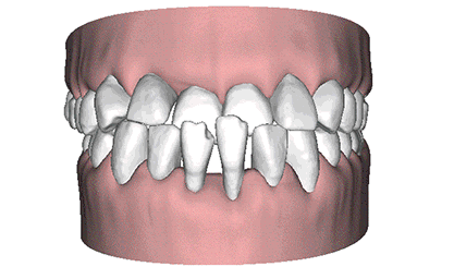 前牙深覆蓋動畫圖解 前牙深覆蓋動畫圖解