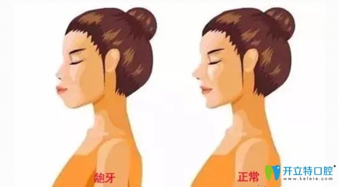 廣州齙牙矯正哪個(gè)醫(yī)院好？隱形矯正可以解決齙牙問題嗎？