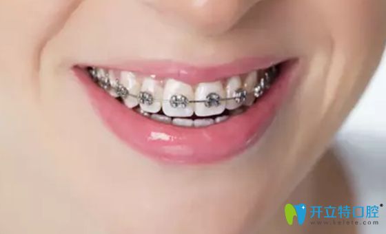 roth托槽和mbt托槽的區(qū)別,及MBT直絲弓矯正價格的專業(yè)介紹