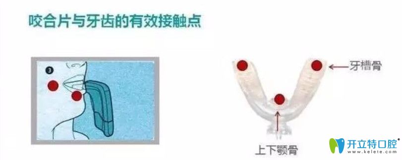 通過牙齒矯正加速器的原理來了解美國美速達正畸加速器吧