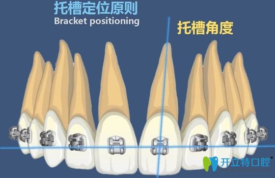 正畸時(shí)托槽定位原則示意圖