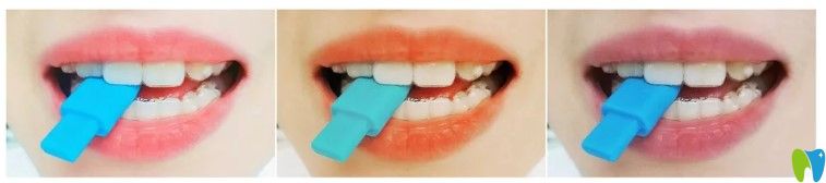 隱適美牙套需要戴多長時間