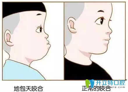 地包天和正常牙齒對比圖